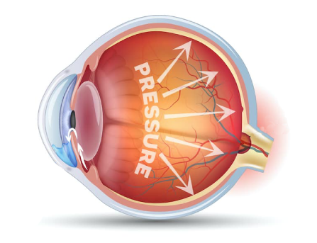 glaucoma